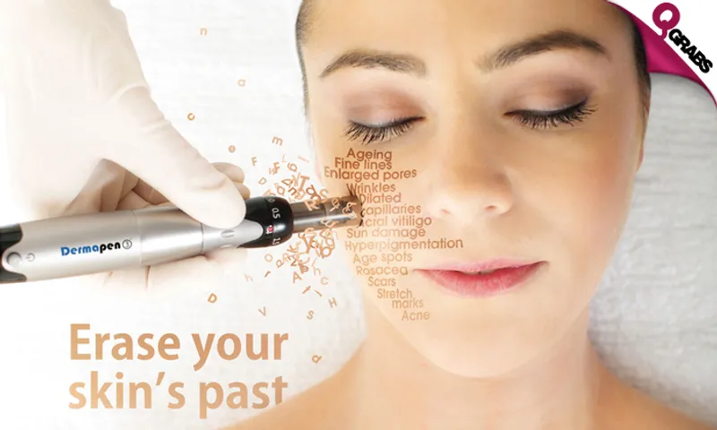Dermapen & Acne Therapy Sessions!